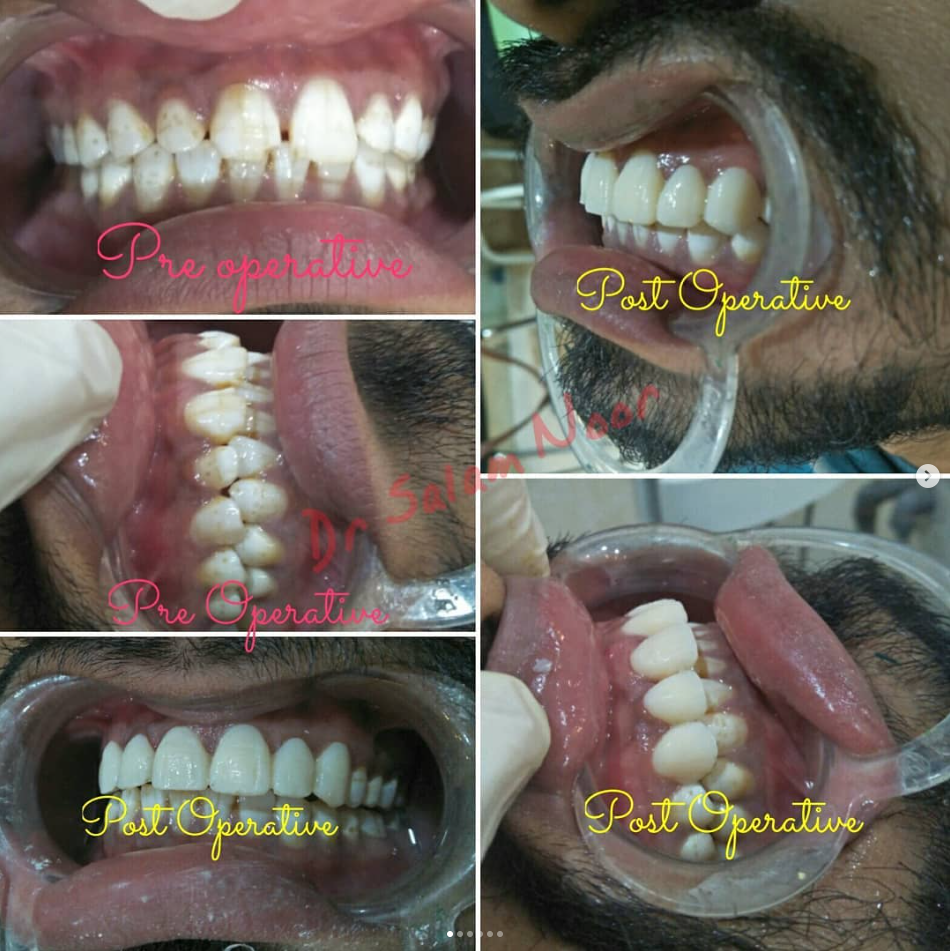 Full-mouth Smile Transformation