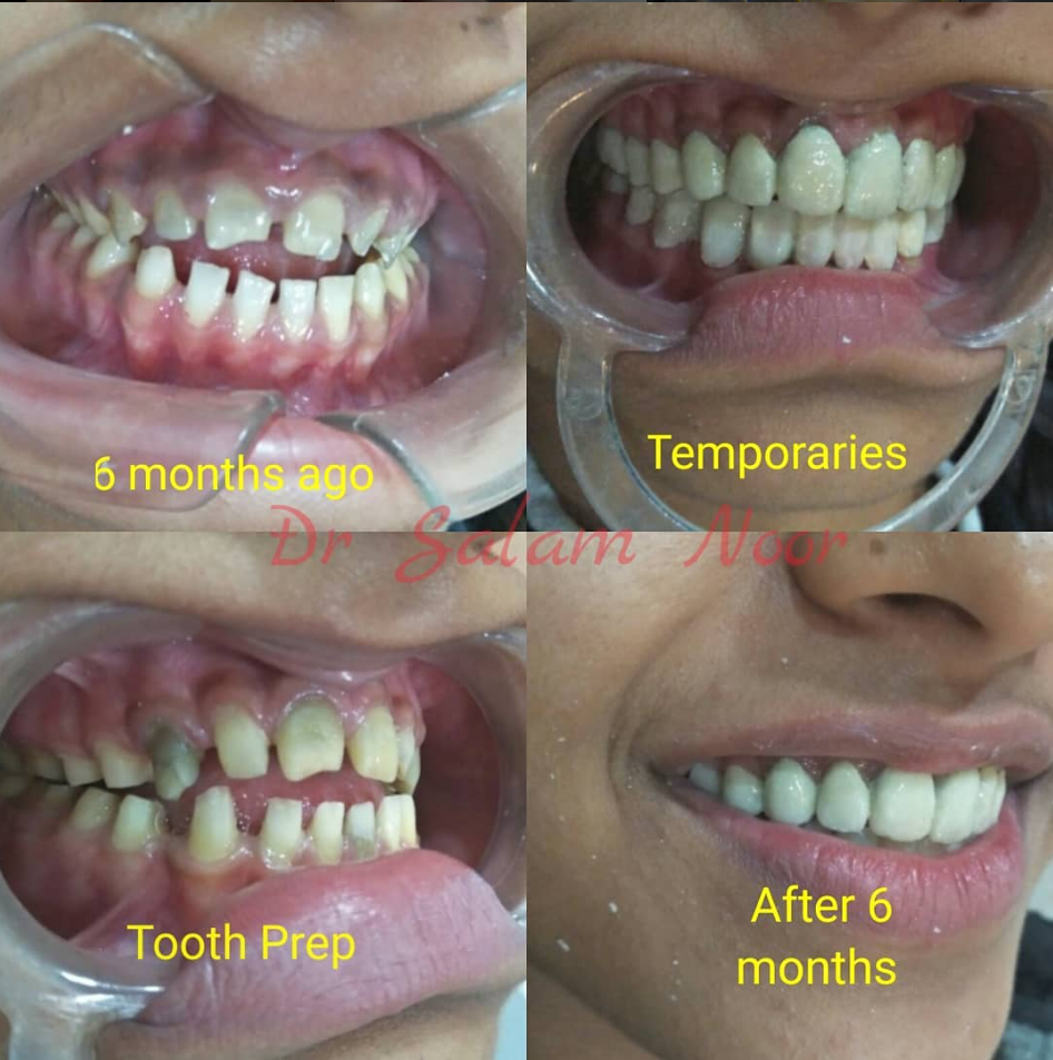 Six-month Smile Transformation
