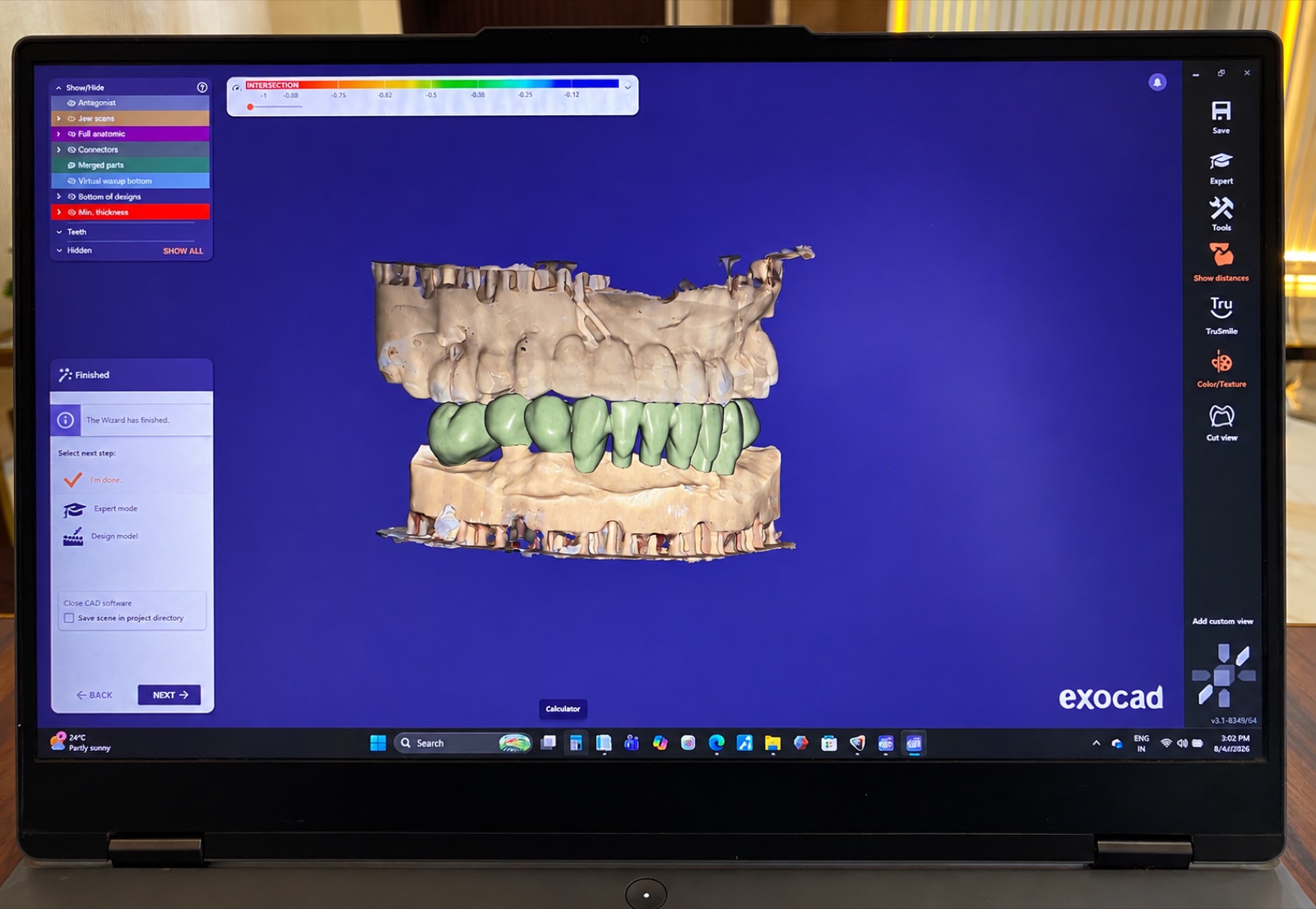 EXOCAD Digital Smile Design